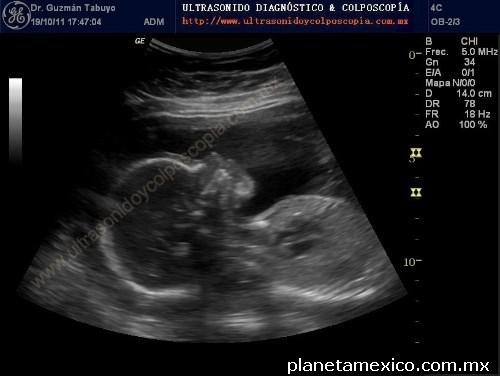 Ultrasonido Obstétrico Perfil Biofísico Fetal En Coyoacán 5946